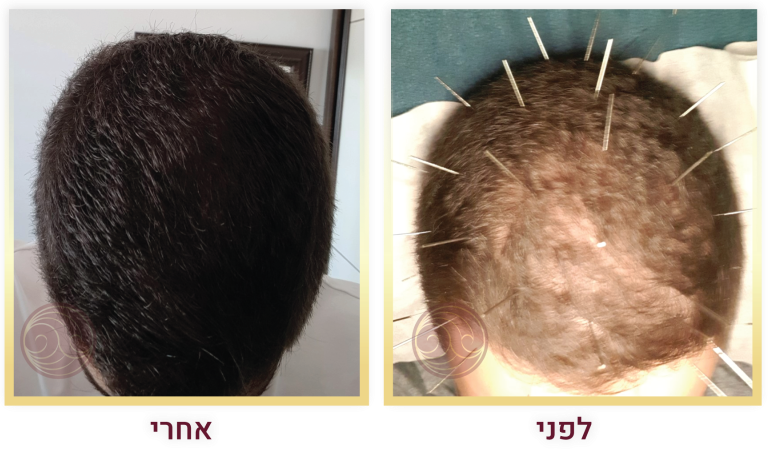 לפני אחרי 2-03 768
